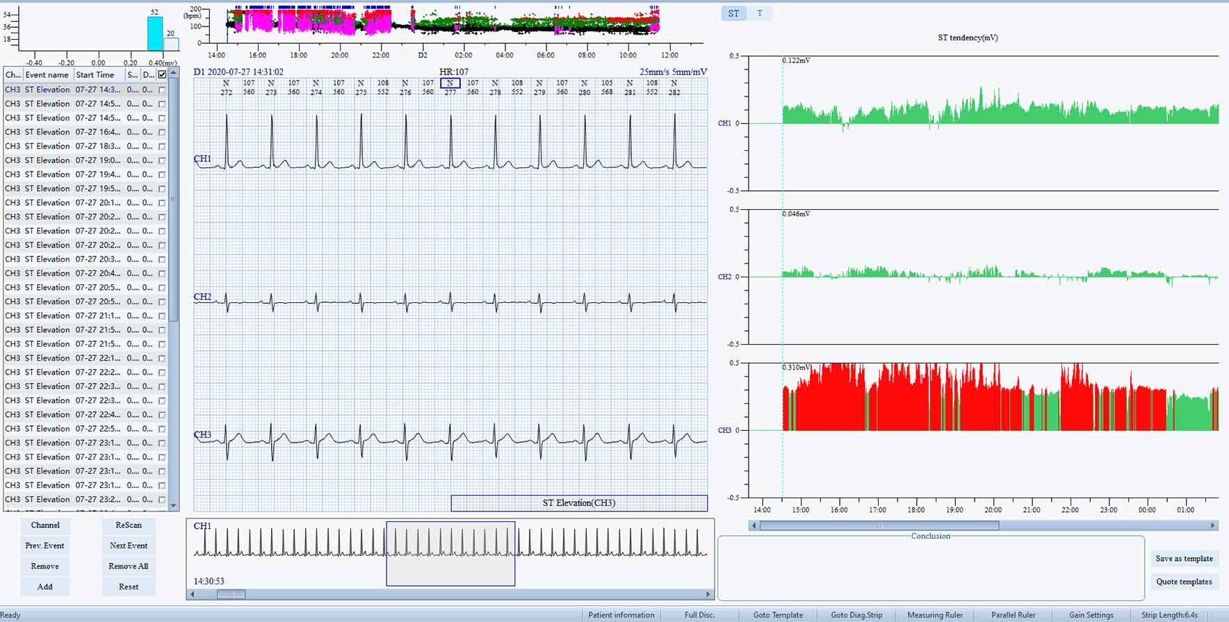 ST-T Segment Analysis