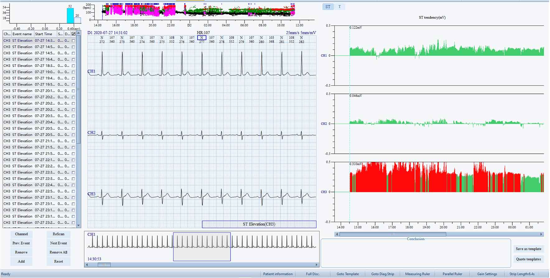 ST-T Segment Analysis