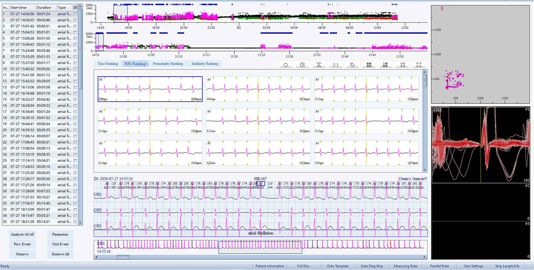 Atrial Fibrillation Edit